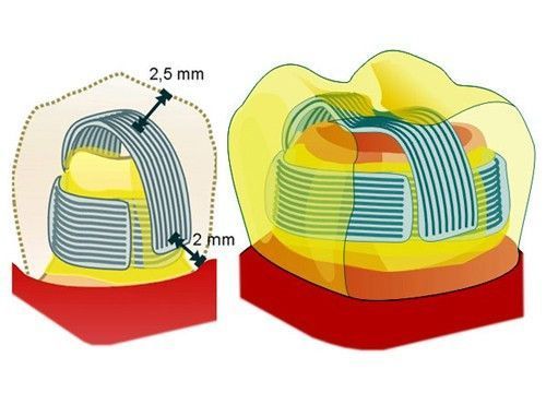 Система шини DENTAPREG SPLINT SFU 422048272 фото