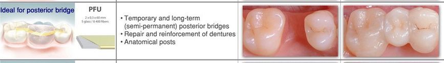 Система шини DENTAPREG BRIDGE PFU 422061483 фото