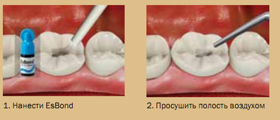 Использование EsBond, иллюстрация 1