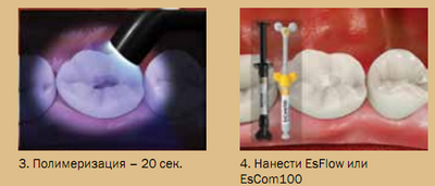 Использование EsBond, иллюстрация 2